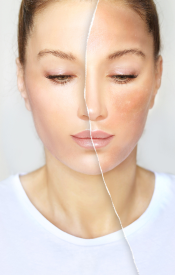 YÜZÜMDEKİ LEKELERİ NASIL YOK EDEBİLİRİM?